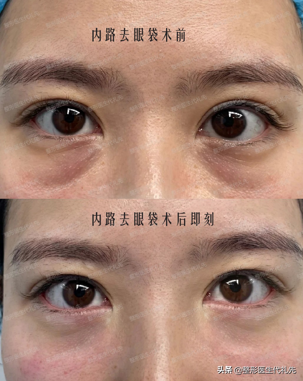 去眼袋一问一答,祛眼袋要咨询什么问题