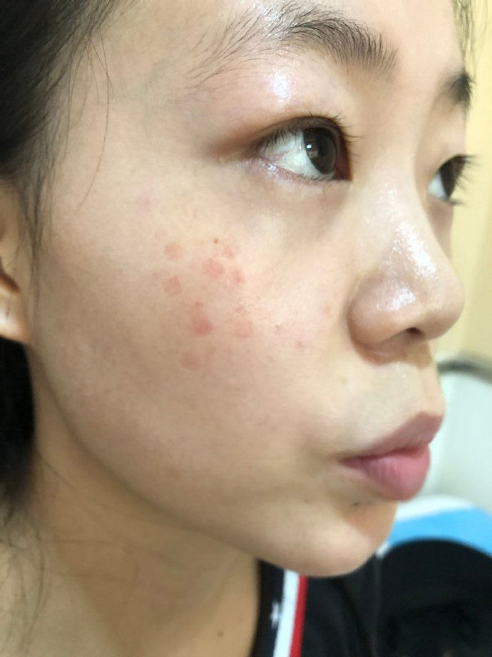 点阵激光能修复到什么程度,点阵激光凹陷疤痕能修复多少