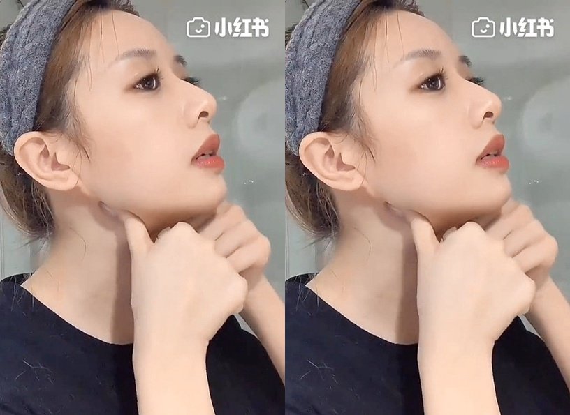 练精致下颚线,徐睿知脸部提升