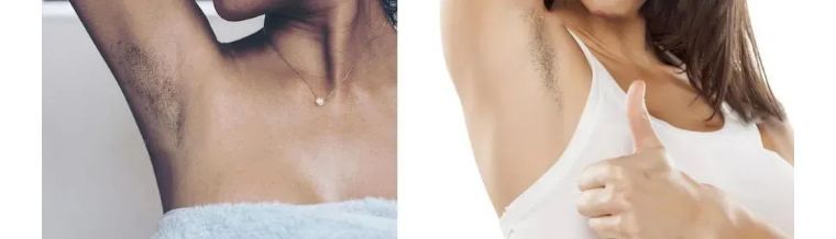 j-style冰点脱毛仪,j-style光子嫩肤脱毛仪