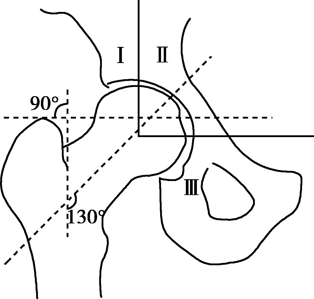 髋关节翻修术手术流程,人工髋关节翻修材料的选择