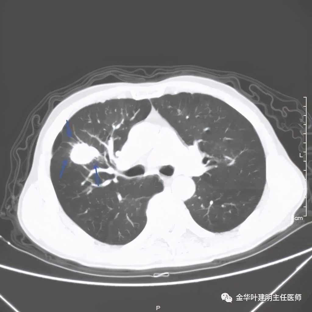 得了肺癌做肺部穿刺有影响吗,肺部穿刺可以确诊肺癌吗