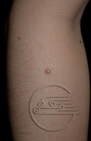 传染性软疣儿童怎么治可以断根,儿童脸上长了传染性软疣怎么办