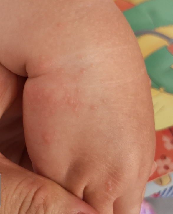 孩子去海边回来过敏什么原因,宝宝去海边玩长一片一片的疹子