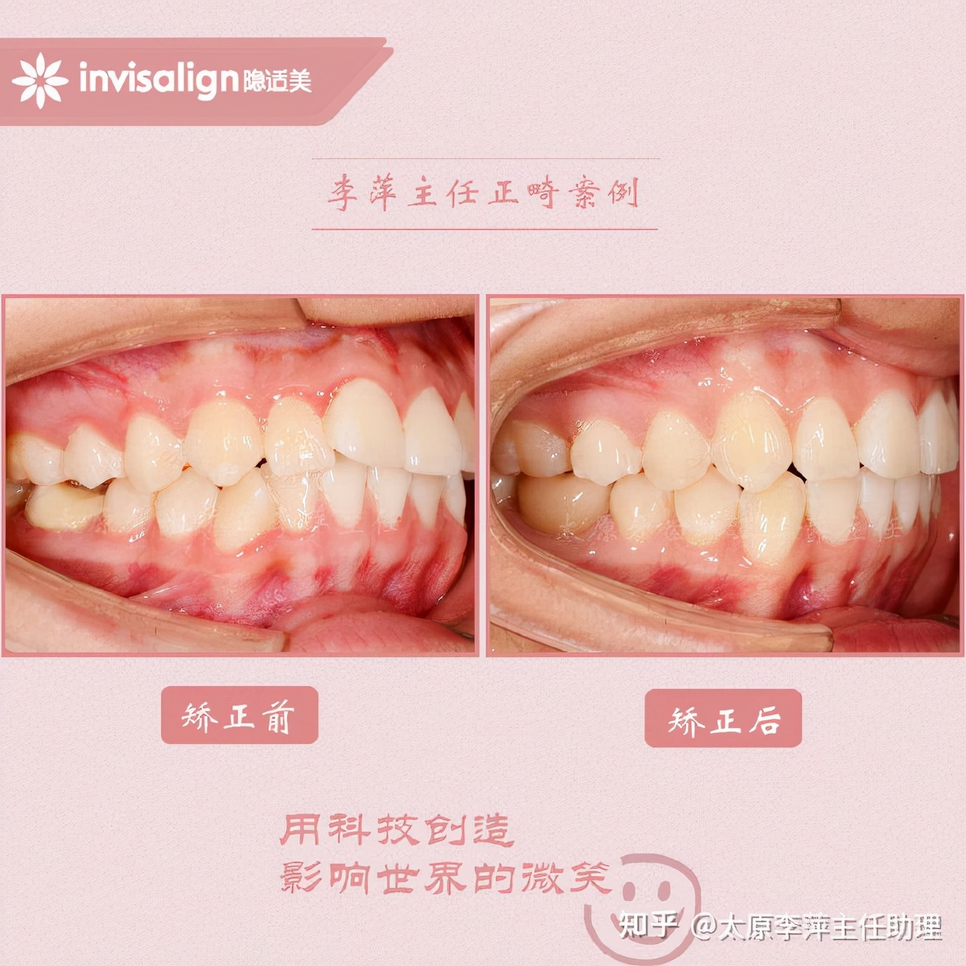 重度拥挤矫正牙齿适合隐形牙套吗,广州成人牙齿矫正推荐隐形牙套