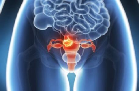 宫颈息肉手术后如何预防复发,放药环预防宫颈息肉对身体好吗