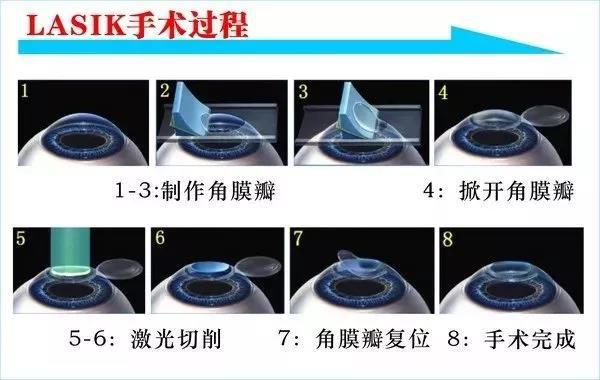 第一个做激光近视的人怎么样了,激光近视经历