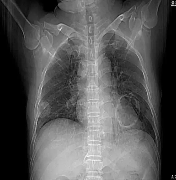 PCCM直播丨中年装修工人双肺多发空洞，奴卡菌＋曲霉菌如何治疗？