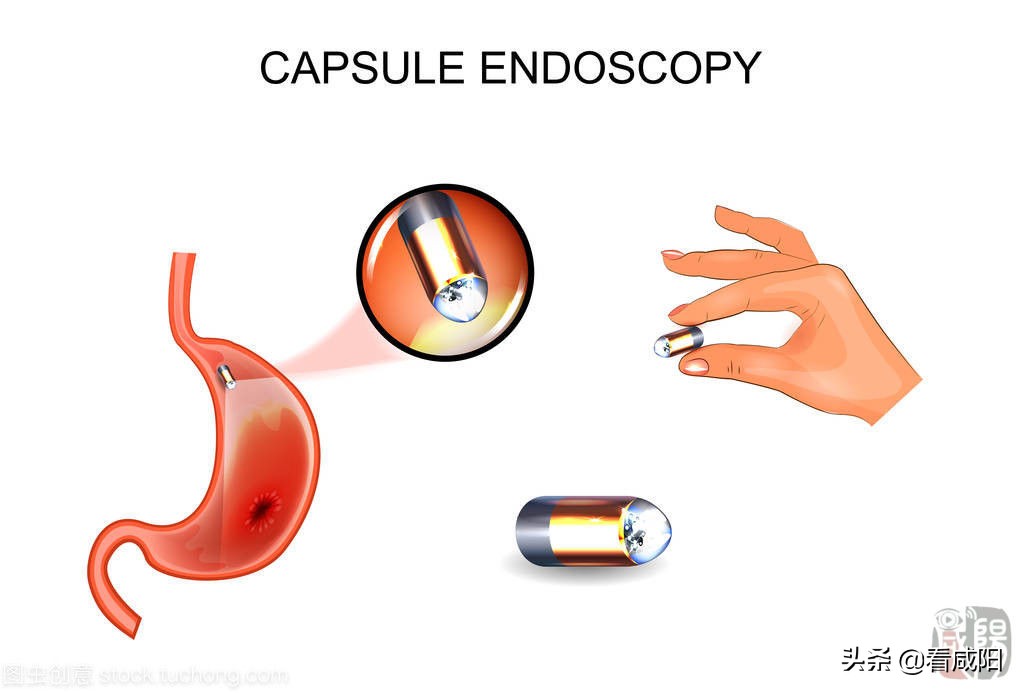 咸阳中心医院：“胶囊”侦查兵让藏匿的胃肠病大呼投降