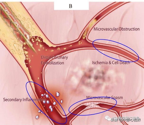 急诊冠状动脉介入治疗中关注冠脉微循环