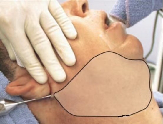 接受不了整形就要正确看待衰老,下颌缘吸脂术后最佳效果多少个月