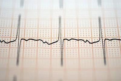 心电图查出窦性心律不齐是什么病,心电图结果窦性心律不齐严重吗