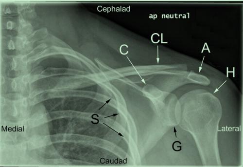肩锁关节脱位治疗,肩锁关节脱位