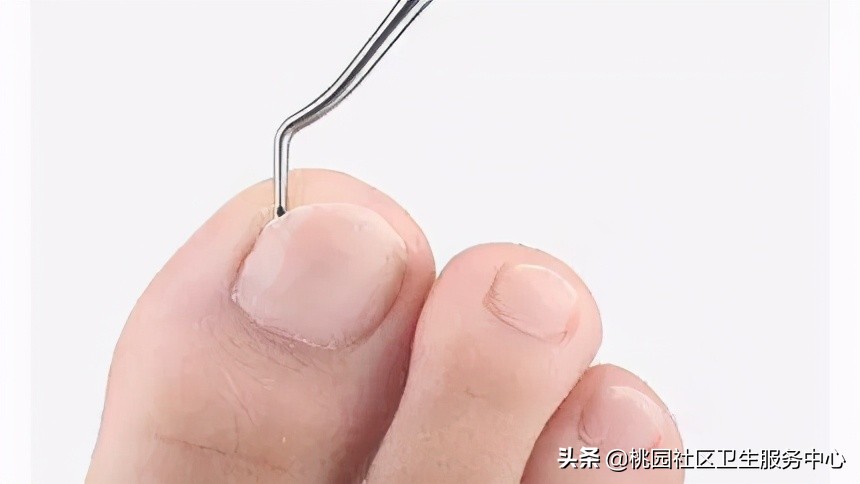 甲沟炎健康之路,健康科普甲沟炎