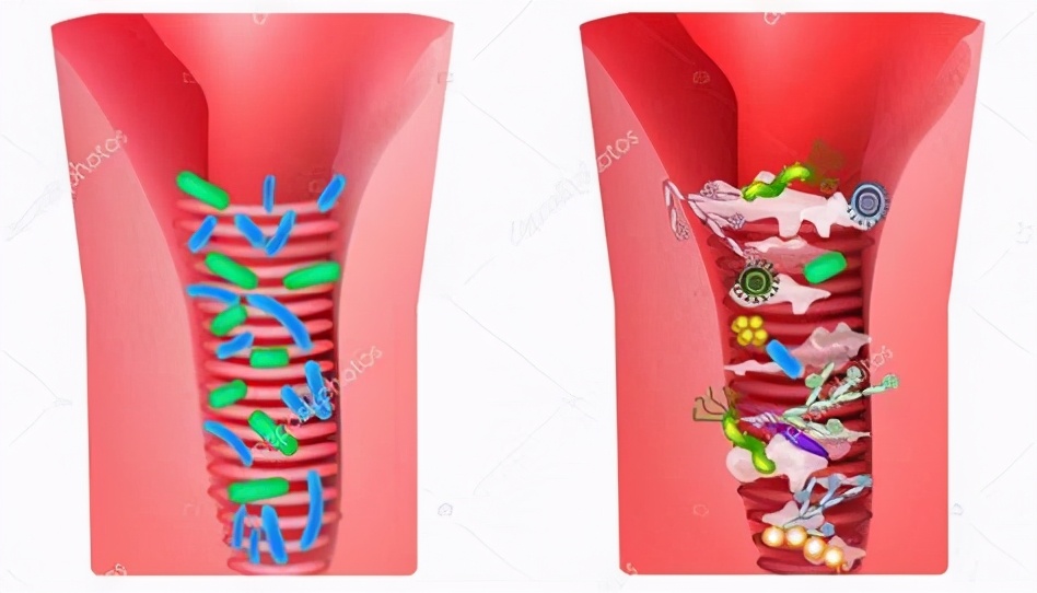 科普丨阴道炎可能引起卵巢癌?年轻女性要小心了