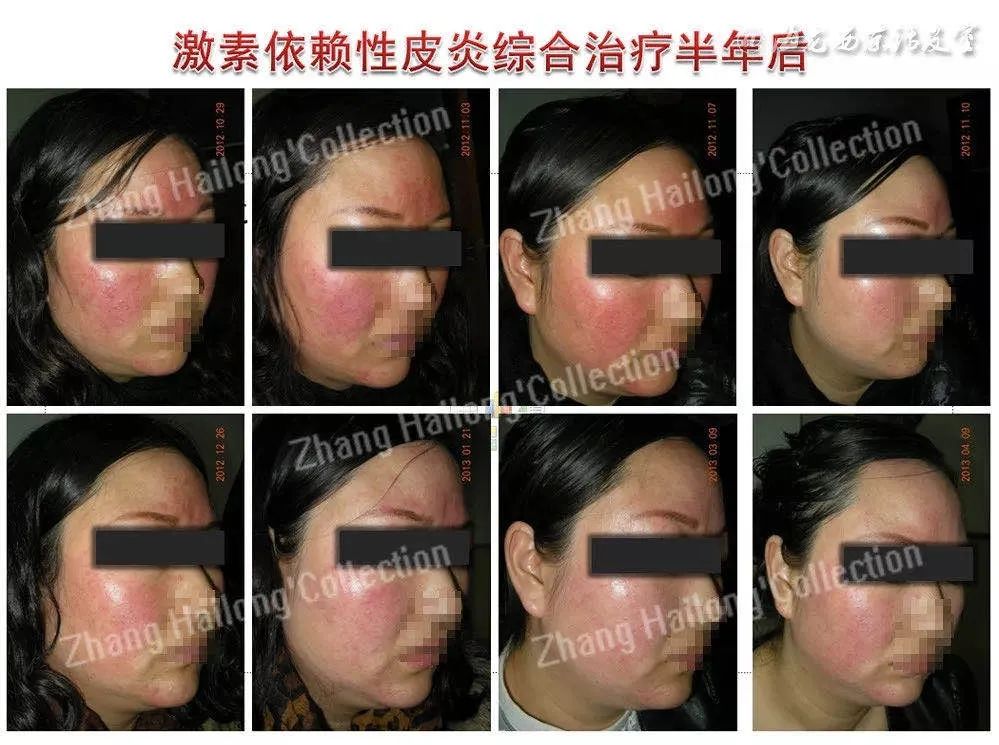 激素依赖性皮炎可以彻底根除吗,激素依赖性皮炎能根除吗