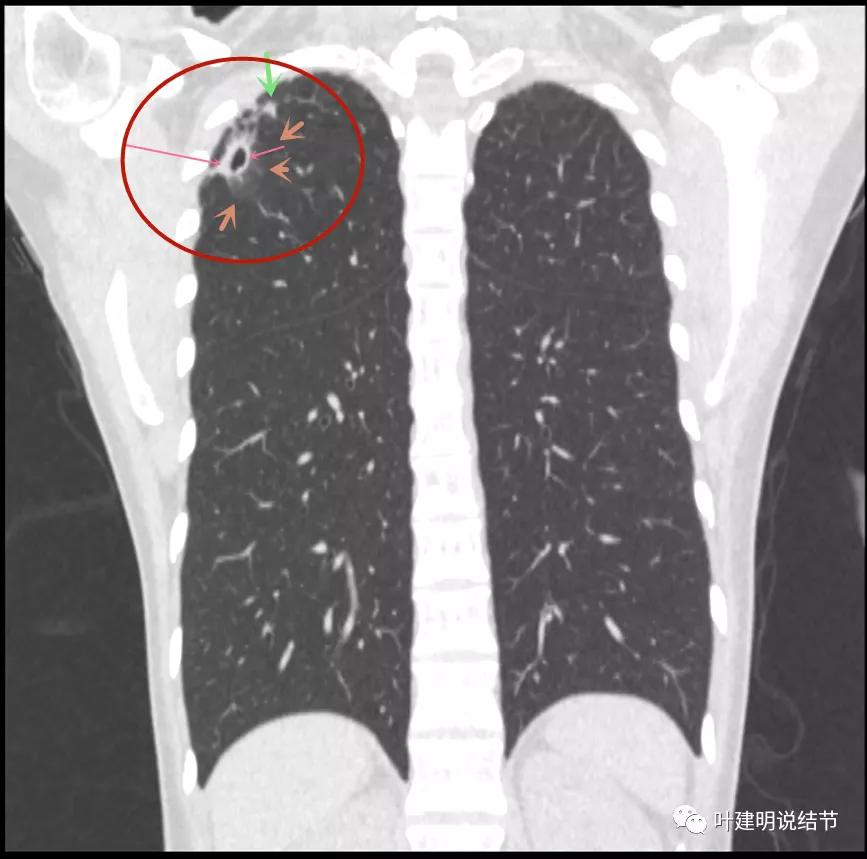 临床诊断孤立性肺结节,空洞型结节一般是什么性质