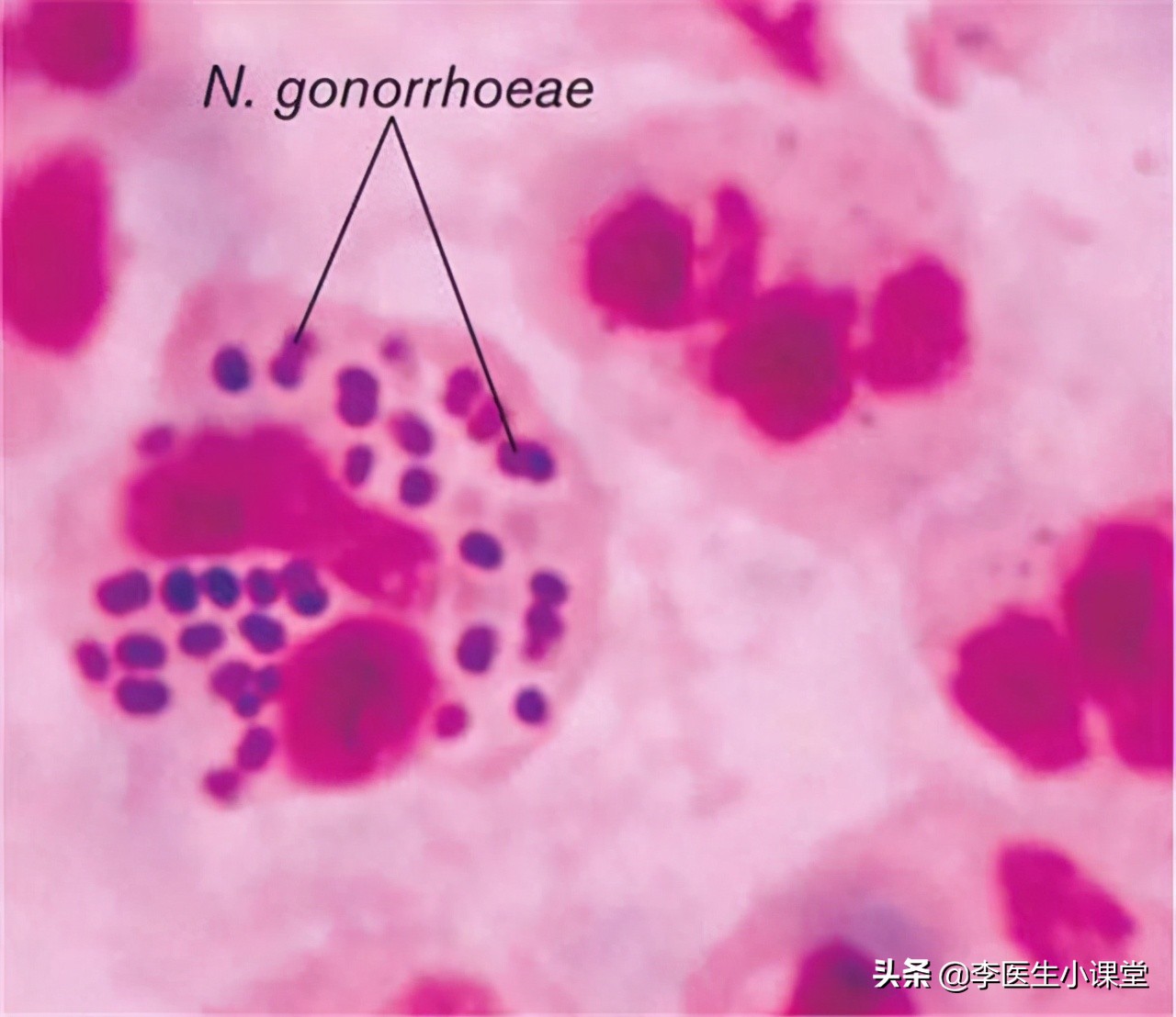 怎么预防淋病传染给家人,高锰酸钾可以预防淋病么