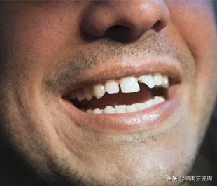 小朋友牙齿撞坏了怎么办,儿童牙齿摔掉了门牙怎么处理