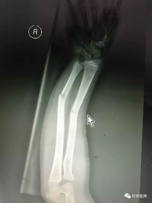 孩子骨折了一定要做打钢针手术吗,儿童摔伤骨折需要手术么