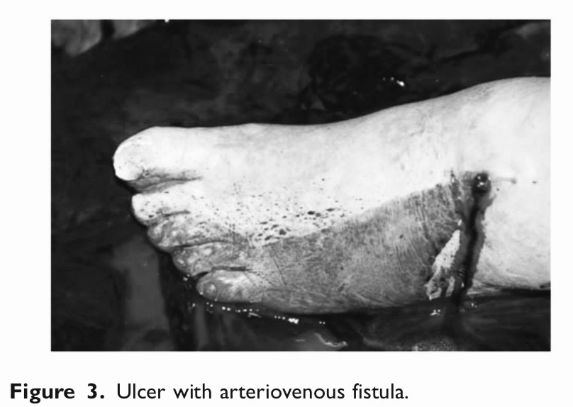 肝硬化胃底静脉曲张重度大出血,肝硬化静脉曲张大出血能活多久