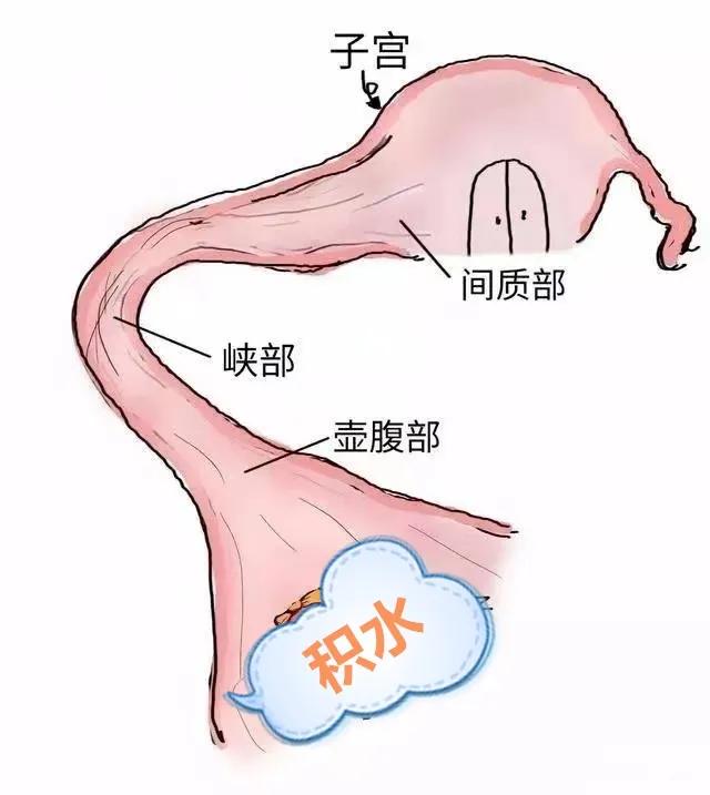 输卵管积水的最佳解决方法,输卵管积水腹腔镜手术