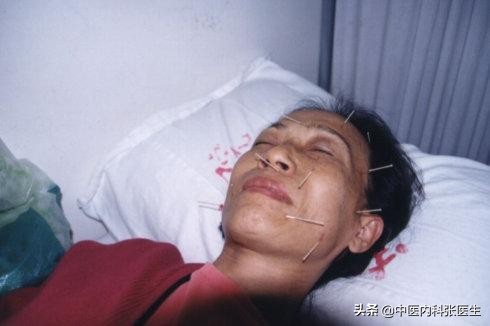 得了面瘫有哪些锻炼方法,得了面瘫怎么样才算完全康复