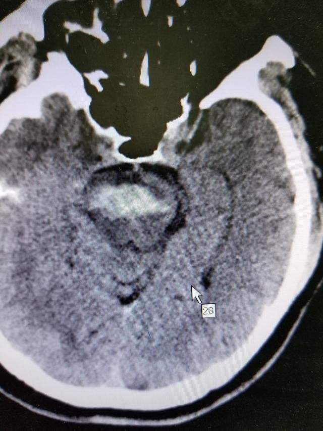 最凶险的脑干出血几毫升也要命，医生提醒：做好5点就能远离它