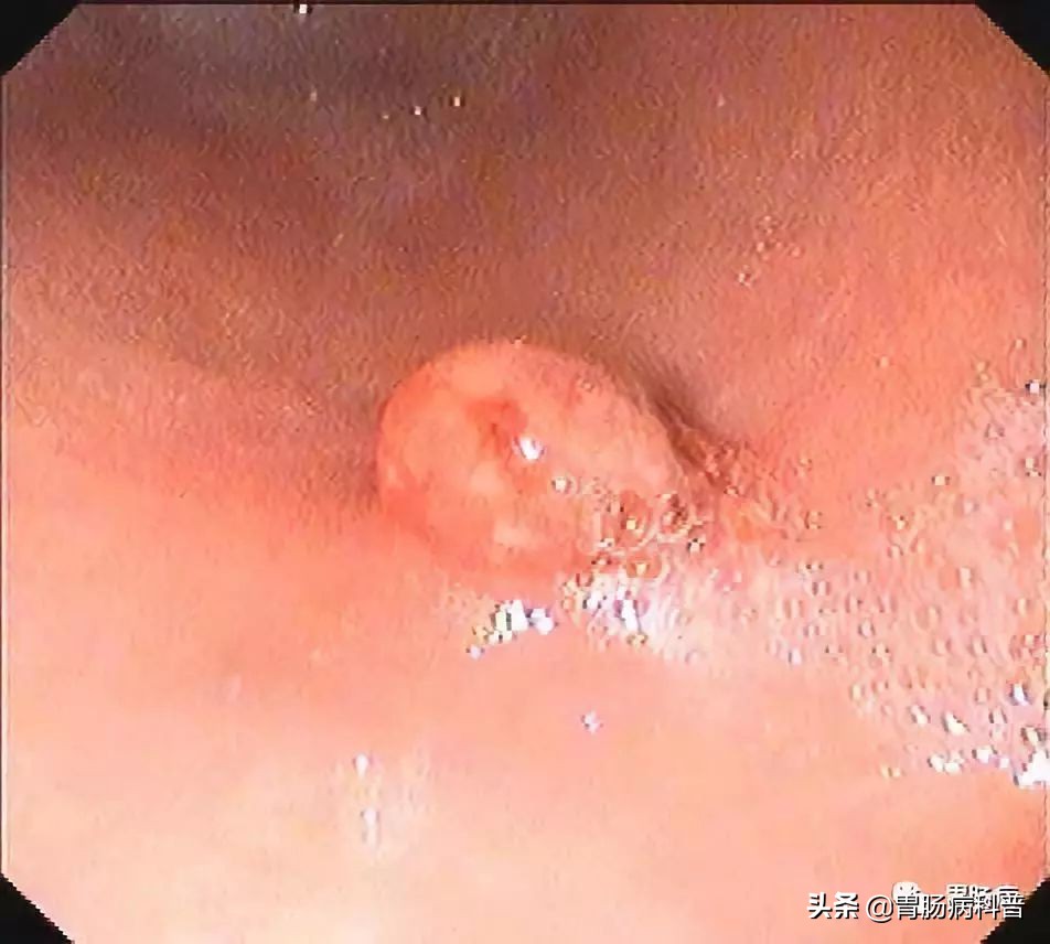 胃长息肉有什么治疗好的方法,长了胃息肉怎么办