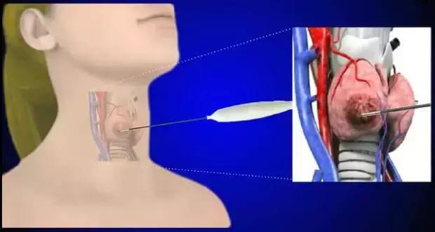 甲状腺良性结节的微创治疗