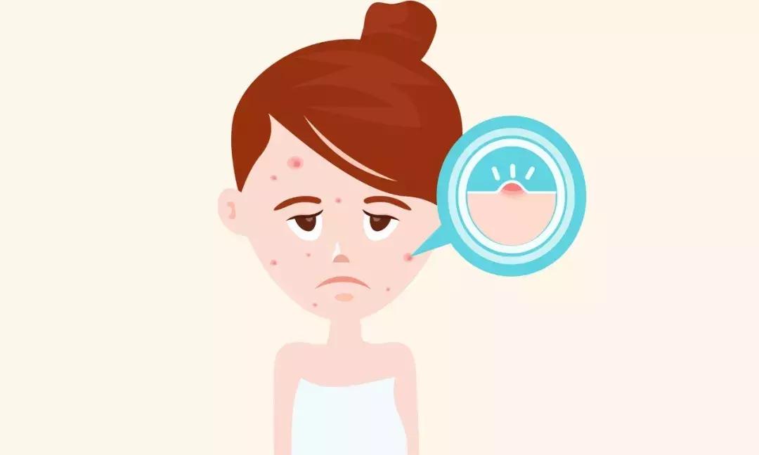 十年的痘痘都有救了,痘痘留下的坑还能修复吗