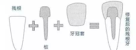 根管治疗后牙齿劈裂怎么办最好,牙齿戴冠还会劈裂