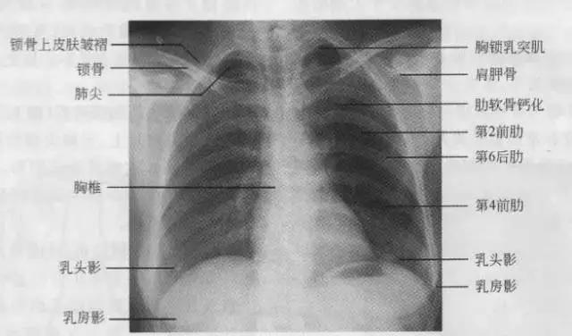 拿到胸部ct我们该怎么看,怎样看懂胸片报告单