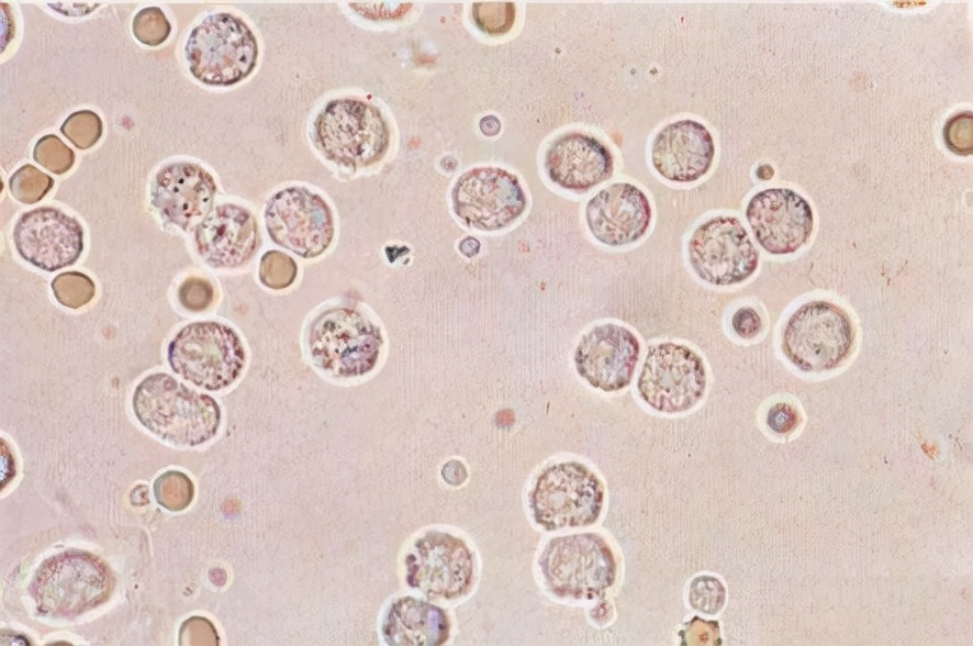 白细胞减少对身体有什么影响,白细胞减少会产生什么后果