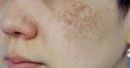 各种面部斑图片,如何辨别脸上的斑