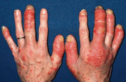 牛皮癣是严重疾病吗,牛皮癣属于什么类疾病