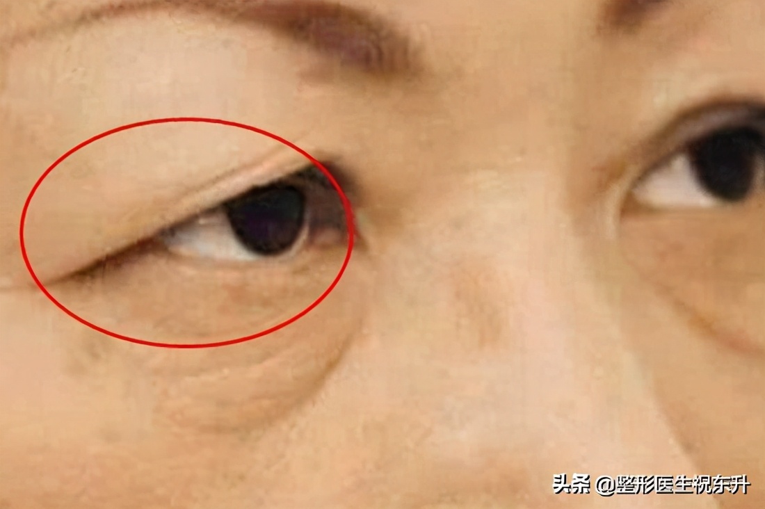 上睑松弛有什么解决办法,上睑皮肤松弛解决的方式有哪些