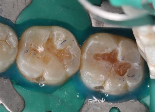 牙齿蛀牙怎么治疗,治疗蛀牙的视频