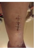 术后伤口要祛疤膏吗,术后伤口拆线后伤口好周围红