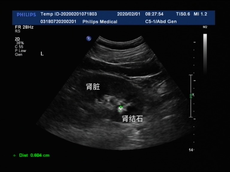 肾结石在尿道怎么快速排出,肾结石到尿道里怎么能快速排出