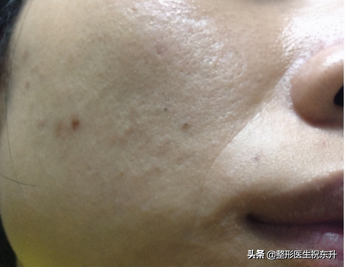 法令纹怎么去除男生不会有副作用,去除法令纹最安全有效的方法