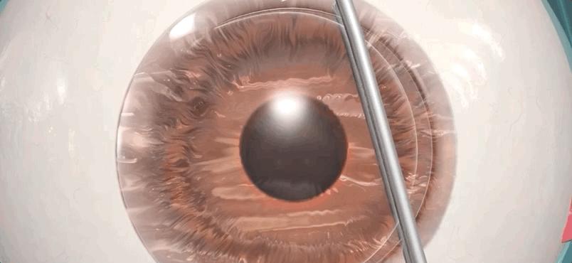 激光近视矫正手术有什么后遗症,激光矫正近视和散光有什么后遗症