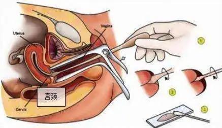 阴道镜检查宫颈癌是早期症状吗,做宫颈癌活检筛查有什么异样