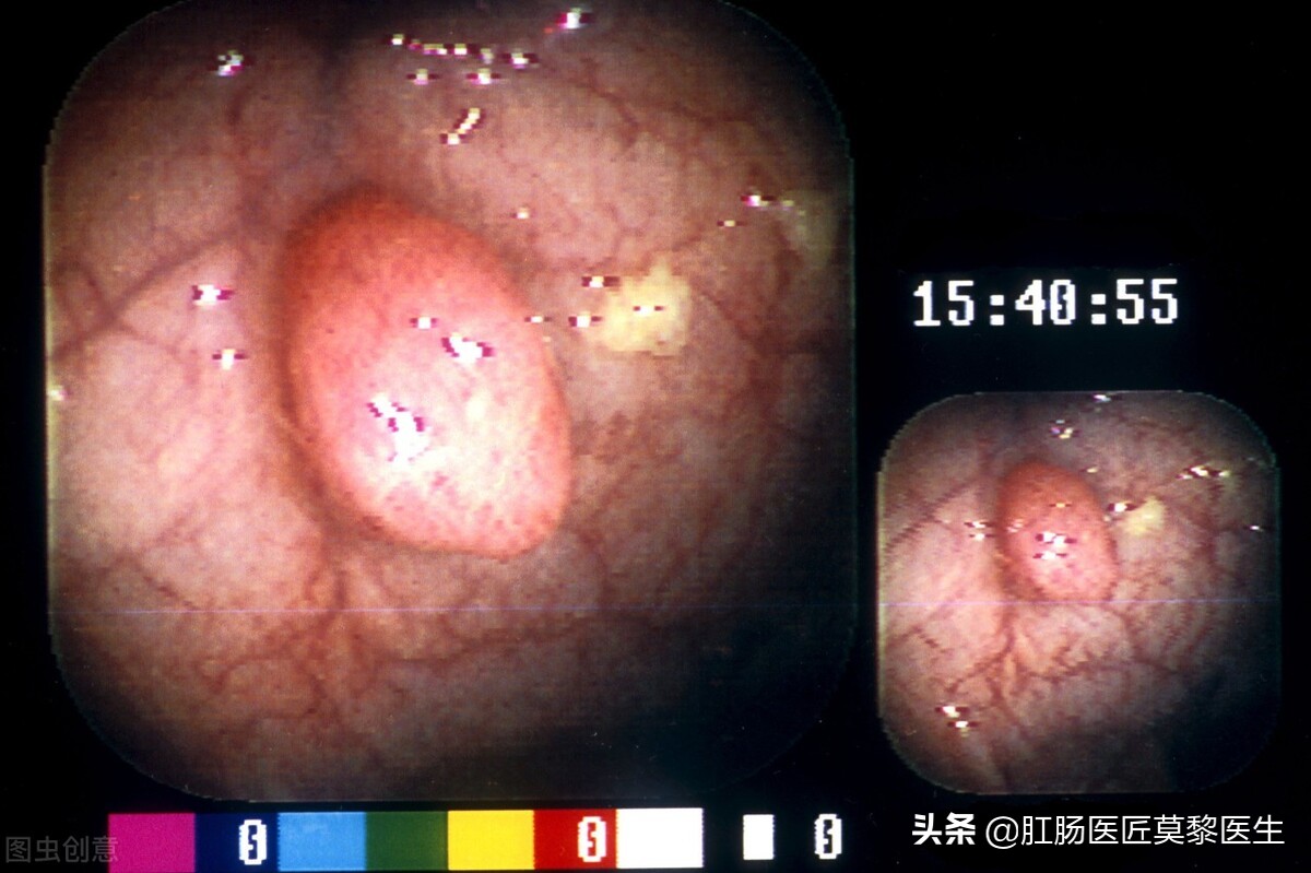 为什么胃肠息肉切除后容易复发,肠道息肉切除后还会复发吗