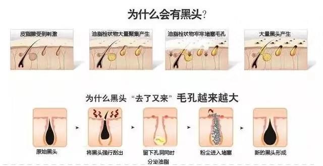 出白头的痘痘怎么治,痘痘冒白头正确处理方法