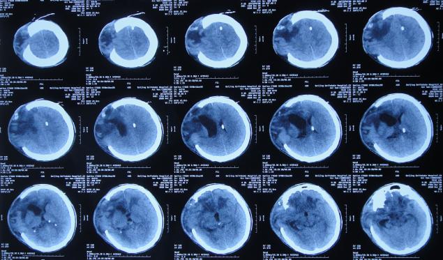 开颅手术后颅内细菌感染图片,外伤开颅手术后脑积液能恢复吗