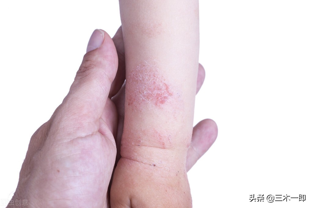 湿疹治愈以后生活注意事项,简单学会一招搞定婴儿湿疹