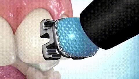 多个牙齿戴牙套矫正的全过程,部分牙齿牙套矫正的全过程