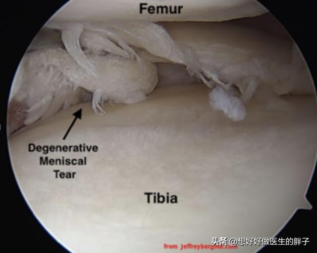 半月板撕裂手术后怎么自己做康复,半月板撕裂手术最佳自愈方法