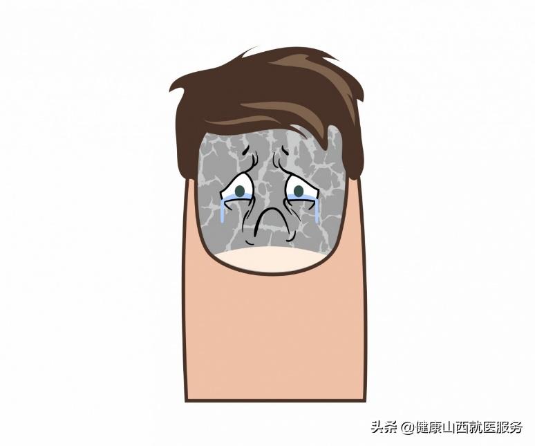 关于网上治疗灰指甲的谣言,白醋治灰指甲是谣言吗